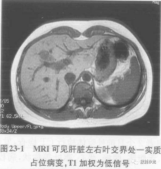 【病例】肝脏炎性假瘤1例MR影像表现 【病例】肝脏炎性假瘤1例MR影像表现