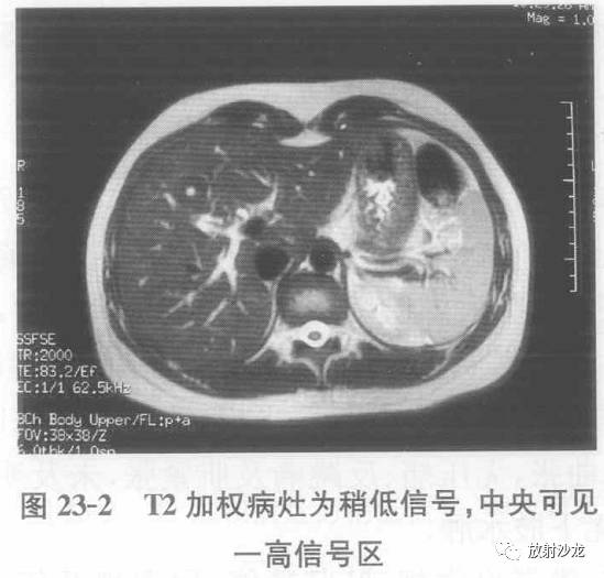 【病例】肝脏炎性假瘤1例MR影像表现