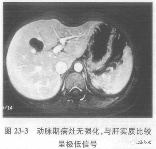 【病例】肝脏炎性假瘤1例MR影像表现 【病例】肝脏炎性假瘤1例MR影像表现