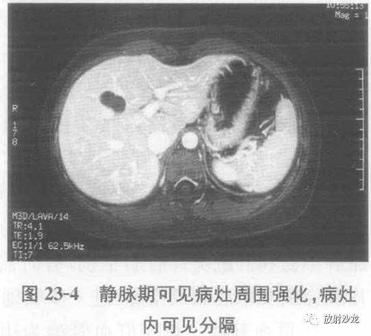 【病例】肝脏炎性假瘤1例MR影像表现 【病例】肝脏炎性假瘤1例MR影像表现