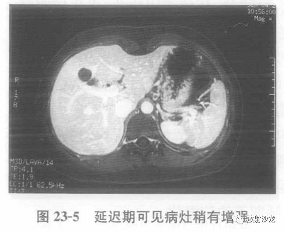 【病例】肝脏炎性假瘤1例MR影像表现 【病例】肝脏炎性假瘤1例MR影像表现