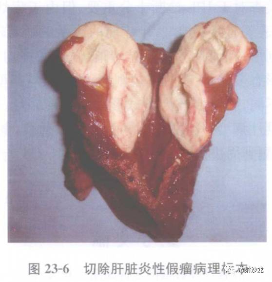 【病例】肝脏炎性假瘤1例MR影像表现 【病例】肝脏炎性假瘤1例MR影像表现