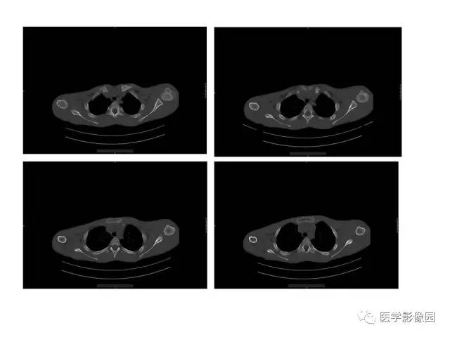 【病例】肱骨上端软骨母细胞瘤1例CT 【病例】肱骨上端软骨母细胞瘤1例CT