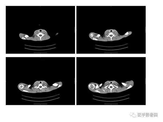 【病例】肱骨上端软骨母细胞瘤1例CT 【病例】肱骨上端软骨母细胞瘤1例CT