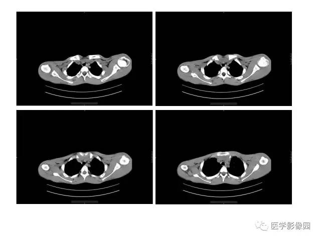 【病例】肱骨上端软骨母细胞瘤1例CT 【病例】肱骨上端软骨母细胞瘤1例CT