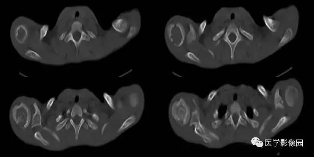 【病例】肱骨上端软骨母细胞瘤1例CT 【病例】肱骨上端软骨母细胞瘤1例CT