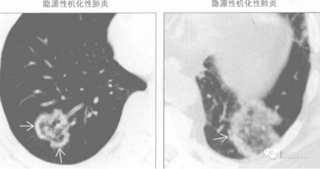 胸部影像学征象——肺部