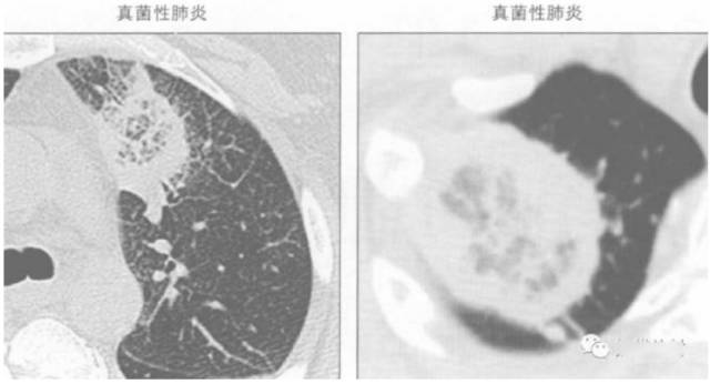 胸部影像学征象——肺部