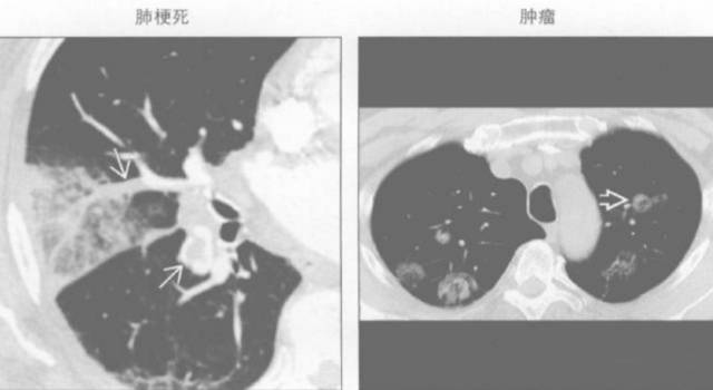 胸部影像学征象——肺部