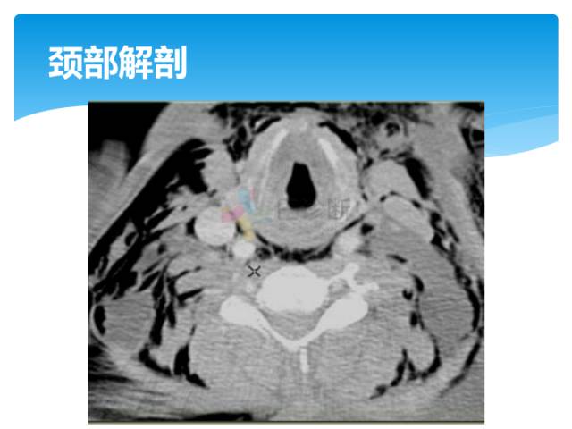 【病例】颈部间隙(舌骨下)解剖和病理