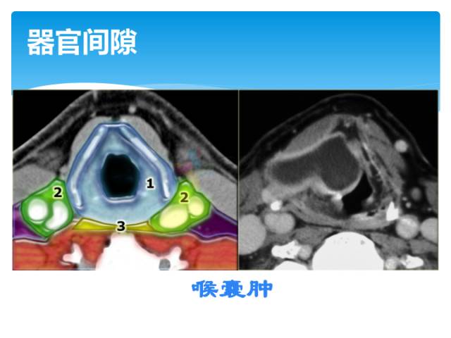 【病例】颈部间隙(舌骨下)解剖和病理