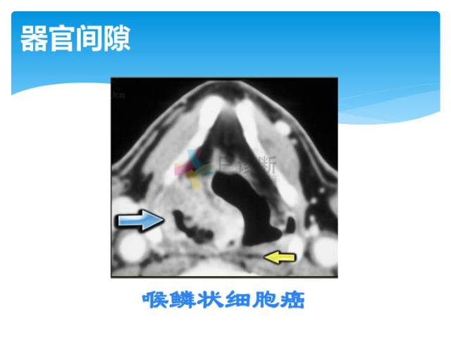 【病例】颈部间隙(舌骨下)解剖和病理