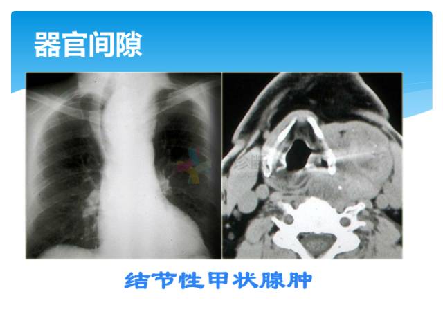 【病例】颈部间隙(舌骨下)解剖和病理