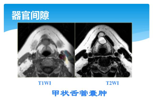 【病例】颈部间隙(舌骨下)解剖和病理