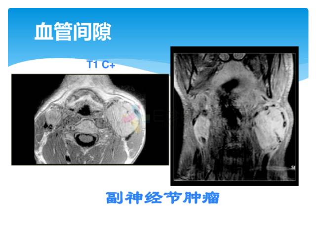 【病例】颈部间隙(舌骨下)解剖和病理