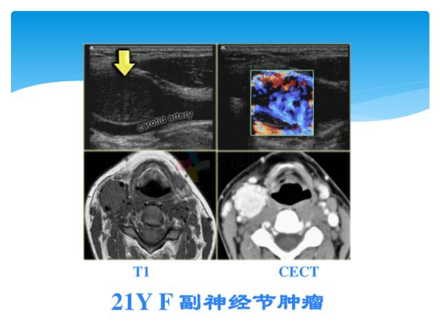 【病例】颈部间隙(舌骨下)解剖和病理