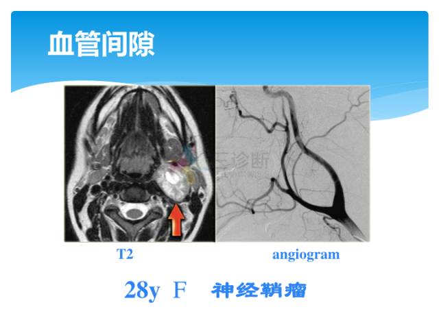 【病例】颈部间隙(舌骨下)解剖和病理
