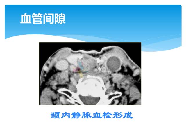 【病例】颈部间隙(舌骨下)解剖和病理