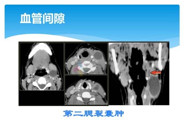 【病例】颈部间隙(舌骨下)解剖和病理