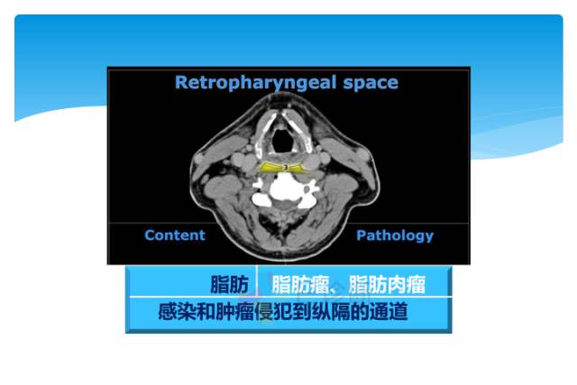 【病例】颈部间隙(舌骨下)解剖和病理