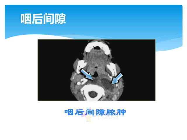 【病例】颈部间隙(舌骨下)解剖和病理