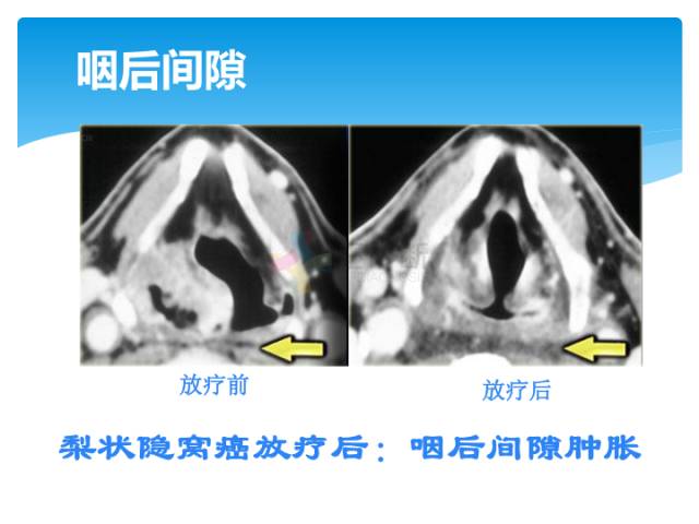 【病例】颈部间隙(舌骨下)解剖和病理