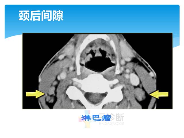 【病例】颈部间隙(舌骨下)解剖和病理