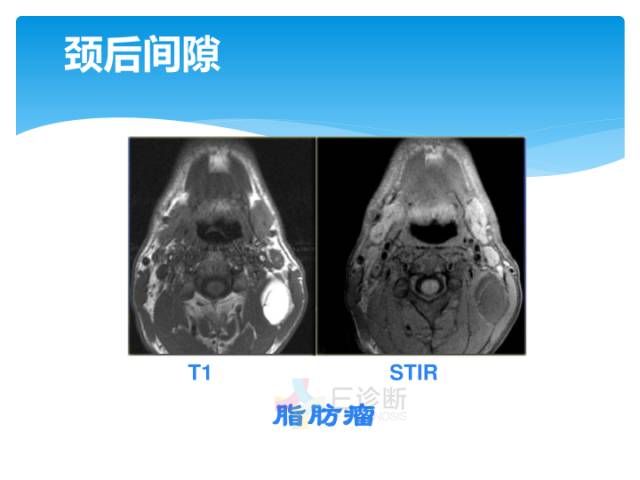 【病例】颈部间隙(舌骨下)解剖和病理