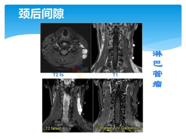 【病例】颈部间隙(舌骨下)解剖和病理