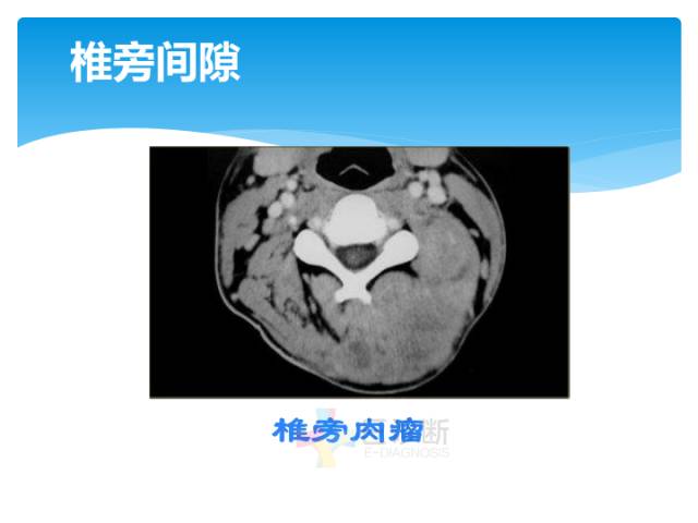 【病例】颈部间隙(舌骨下)解剖和病理