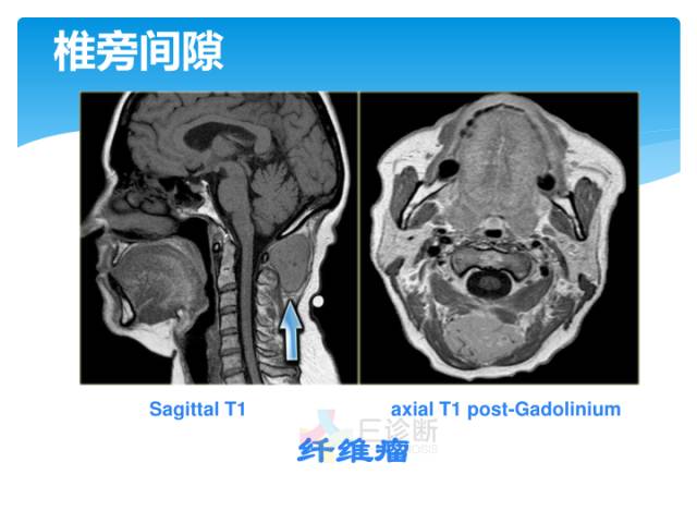 【病例】颈部间隙(舌骨下)解剖和病理