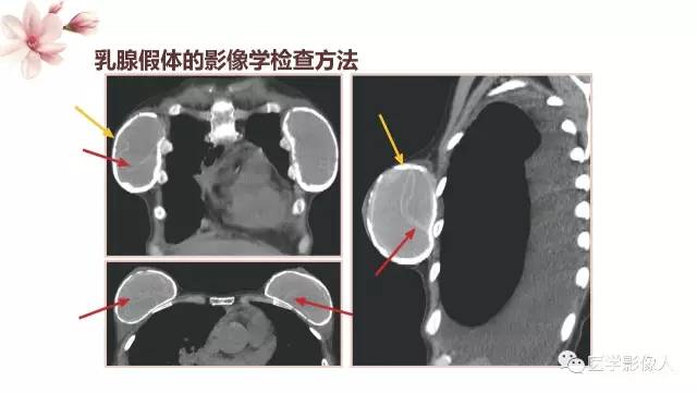 【PPT】乳腺扩大整形术的MRI评价