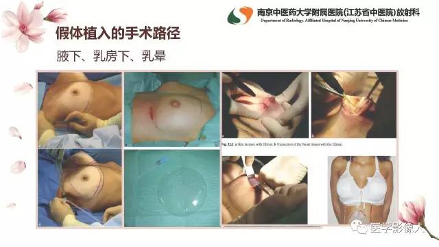 【PPT】乳腺扩大整形术的MRI评价