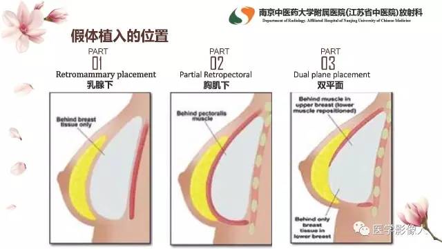 【PPT】乳腺扩大整形术的MRI评价
