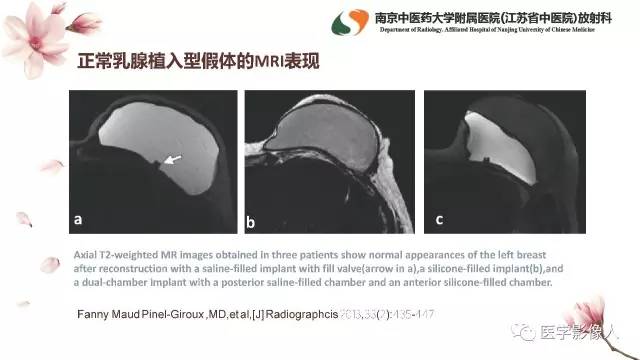 【PPT】乳腺扩大整形术的MRI评价