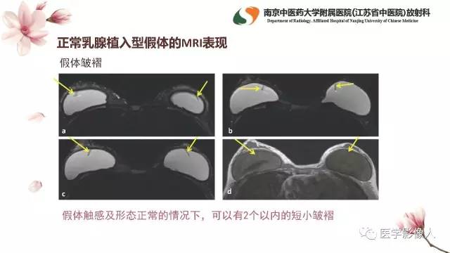 【PPT】乳腺扩大整形术的MRI评价