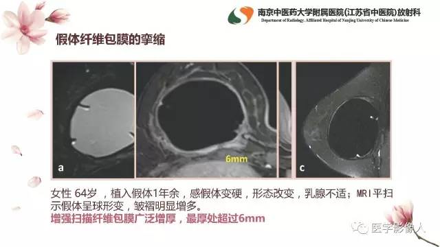 【PPT】乳腺扩大整形术的MRI评价