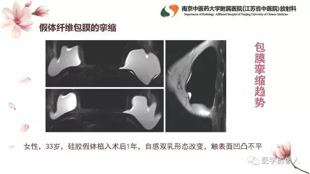 【PPT】乳腺扩大整形术的MRI评价