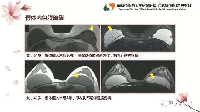 【PPT】乳腺扩大整形术的MRI评价