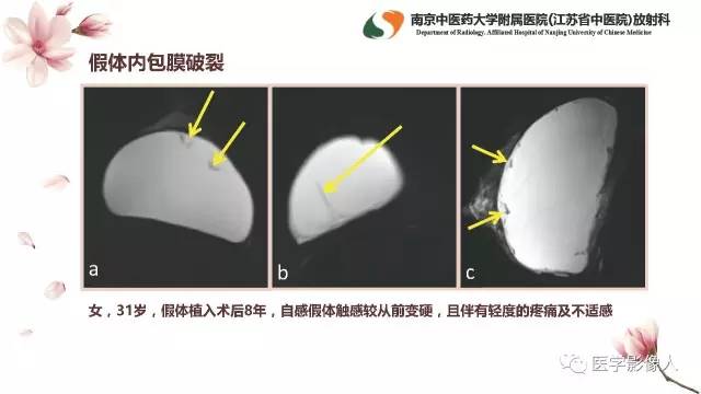 【PPT】乳腺扩大整形术的MRI评价