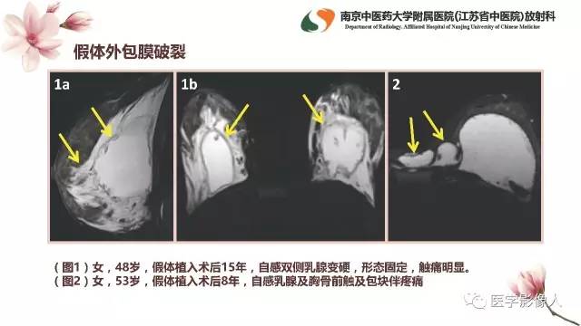 【PPT】乳腺扩大整形术的MRI评价