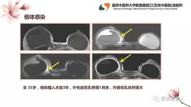 【PPT】乳腺扩大整形术的MRI评价
