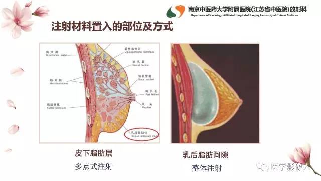 【PPT】乳腺扩大整形术的MRI评价