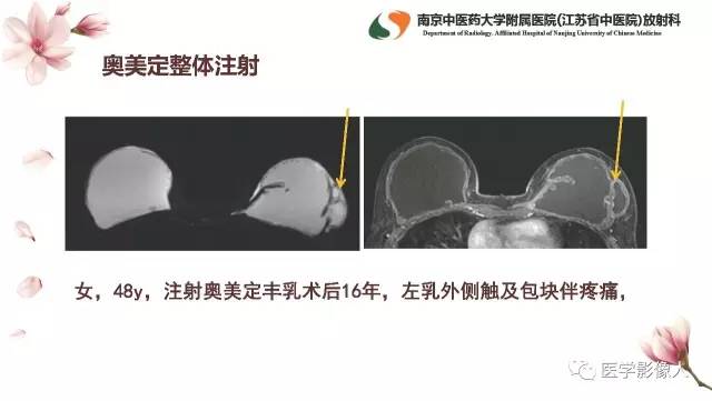 【PPT】乳腺扩大整形术的MRI评价