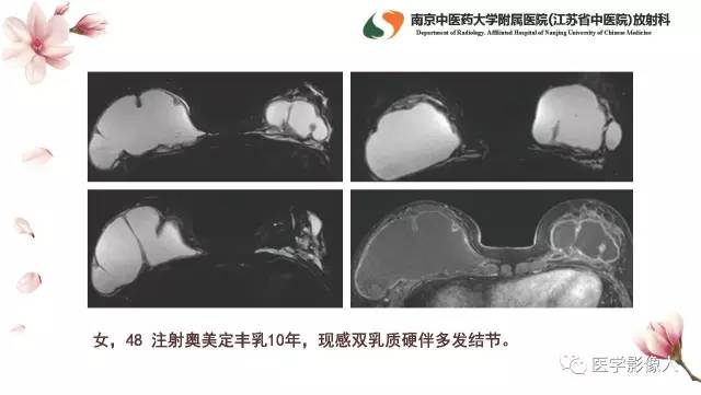 【PPT】乳腺扩大整形术的MRI评价