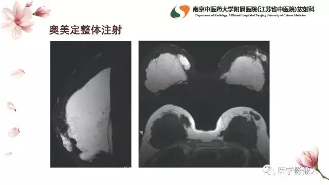 【PPT】乳腺扩大整形术的MRI评价