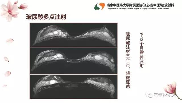 【PPT】乳腺扩大整形术的MRI评价