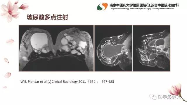 【PPT】乳腺扩大整形术的MRI评价