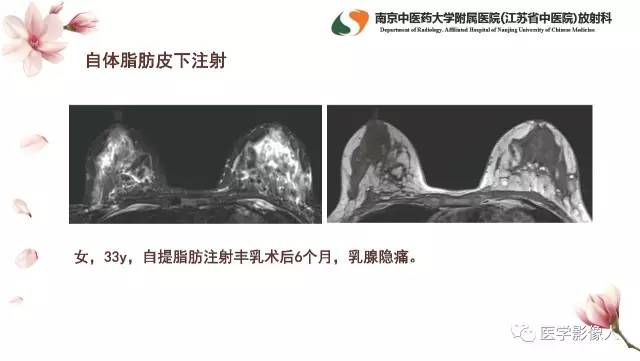 【PPT】乳腺扩大整形术的MRI评价