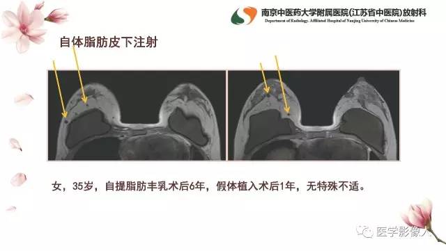 【PPT】乳腺扩大整形术的MRI评价